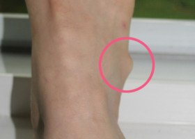 ganglion cyst on foot