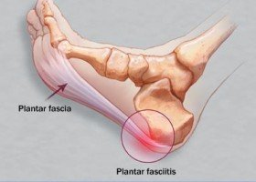 Stone bruise on discount heel of foot treatment
