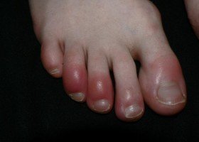 chilblains on the toes