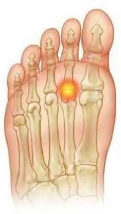 plantar plate rupture