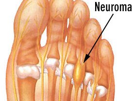 Mortons-Neuroma-diagram