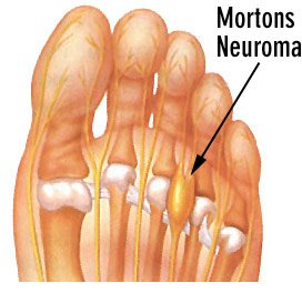 Mortons-Neuroma-diagram